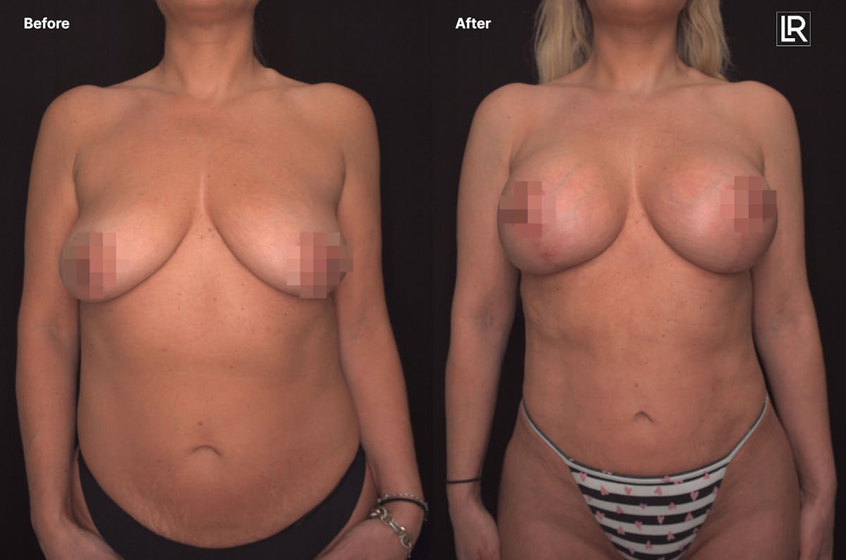 Breast Augmentation Before & After Gallery - Patient 236471 - Image 1