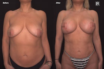 Breast Augmentation Before & After Gallery - Patient 236471 - Image 1