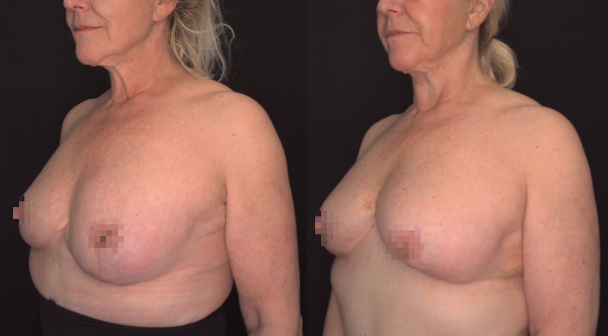 Breast Augmentation Before & After Gallery - Patient 319203 - Image 1