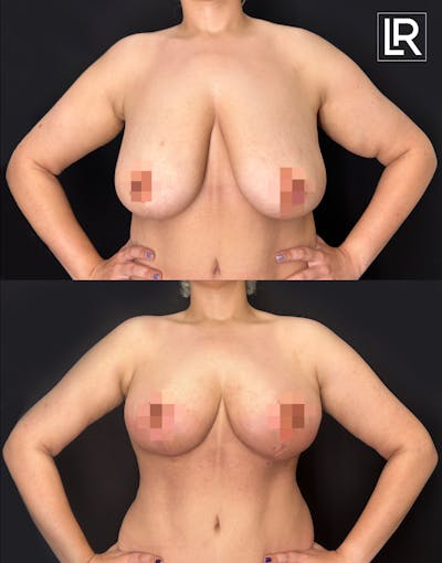 Breast Lift Before & After Gallery - Patient 327016 - Image 1