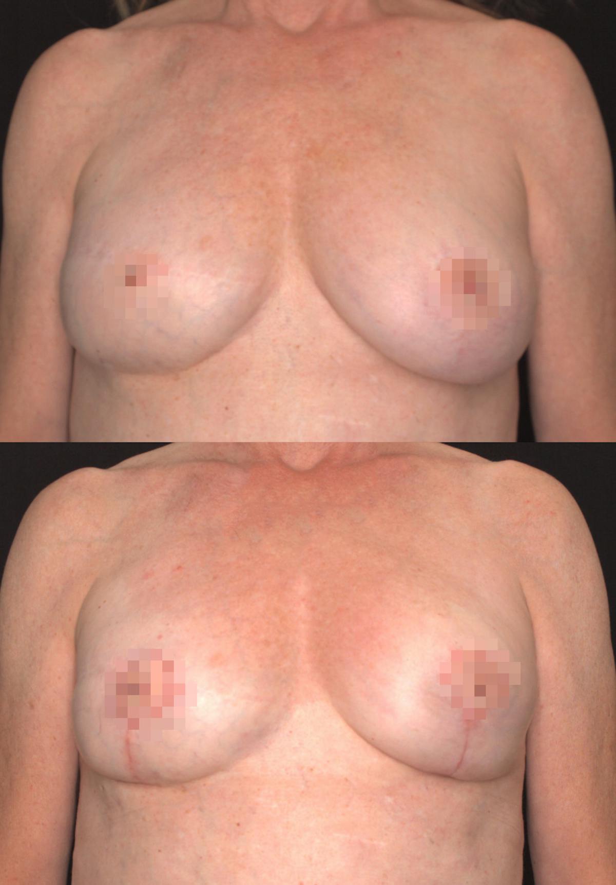 Breast Lift Before & After Gallery - Patient 107561 - Image 1