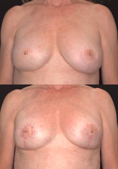 Breast Lift Before & After Gallery - Patient 107561 - Image 1