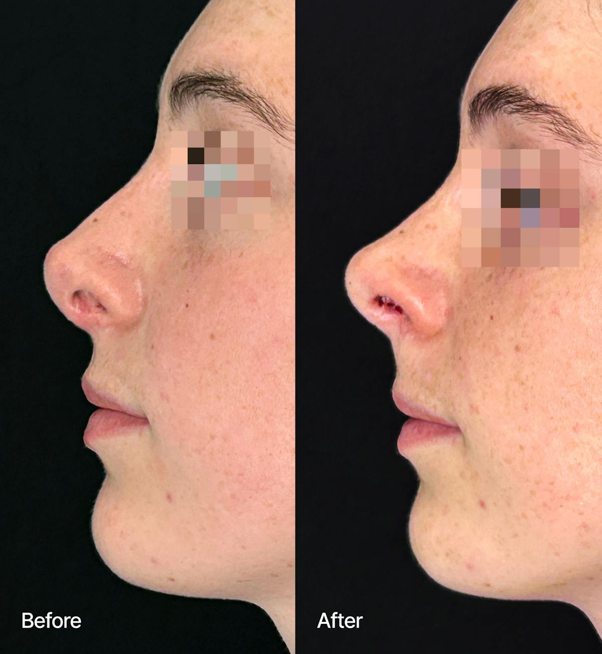 Rhinoplasty Before & After Gallery - Patient 832866 - Image 1