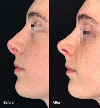 Rhinoplasty Before & After Gallery - Patient 832866 - Image 1