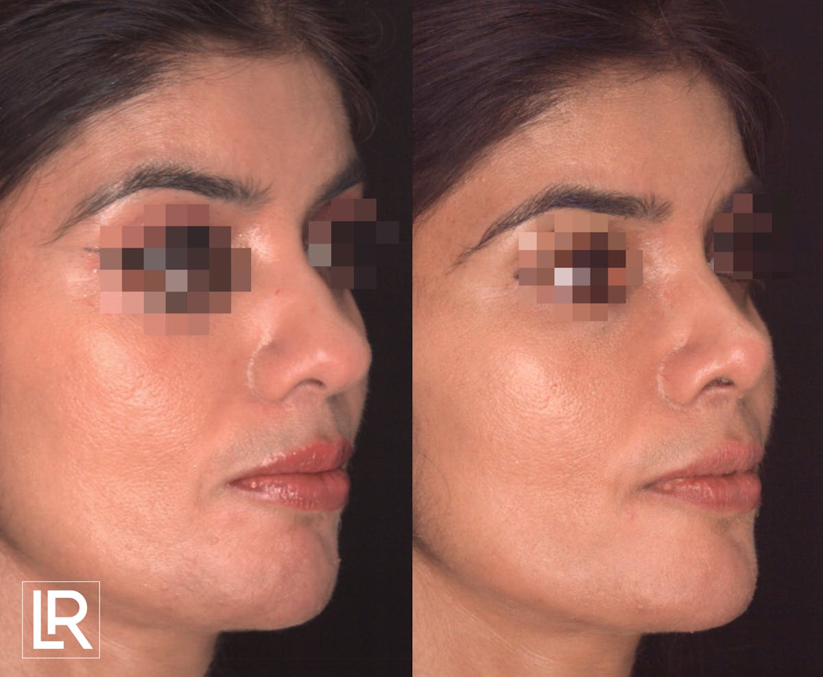 Rhinoplasty Before & After Gallery - Patient 206028 - Image 2