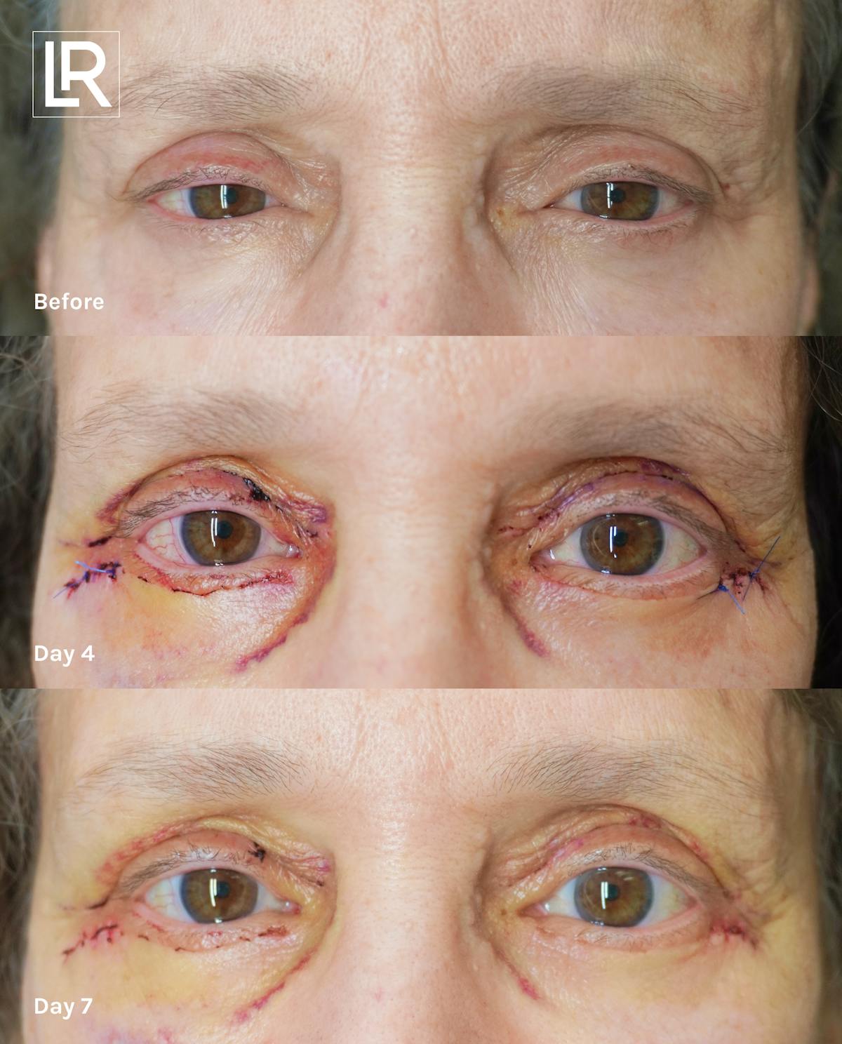 Eyelid Lift Before & After Gallery - Patient 301812 - Image 1
