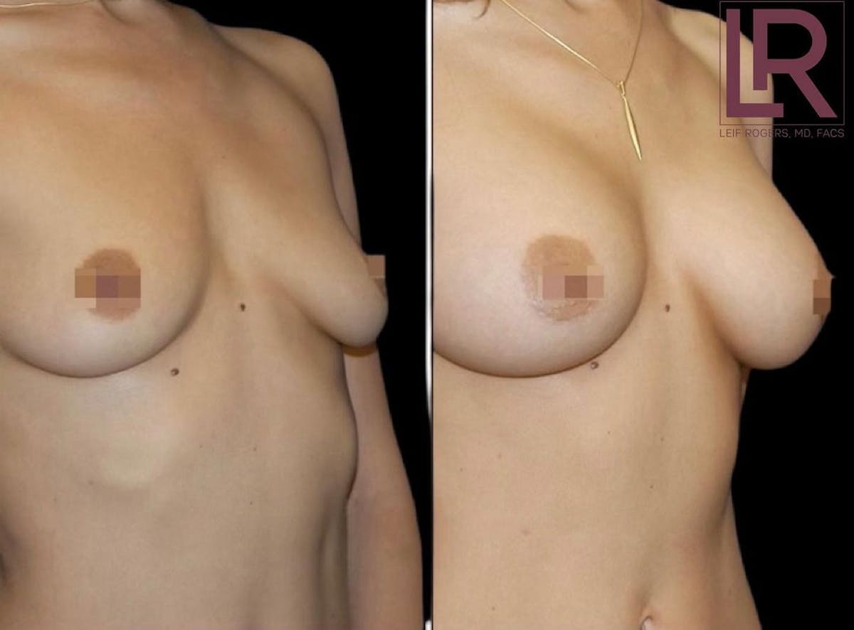 Breast Augmentation Before & After Gallery - Patient 568207 - Image 1