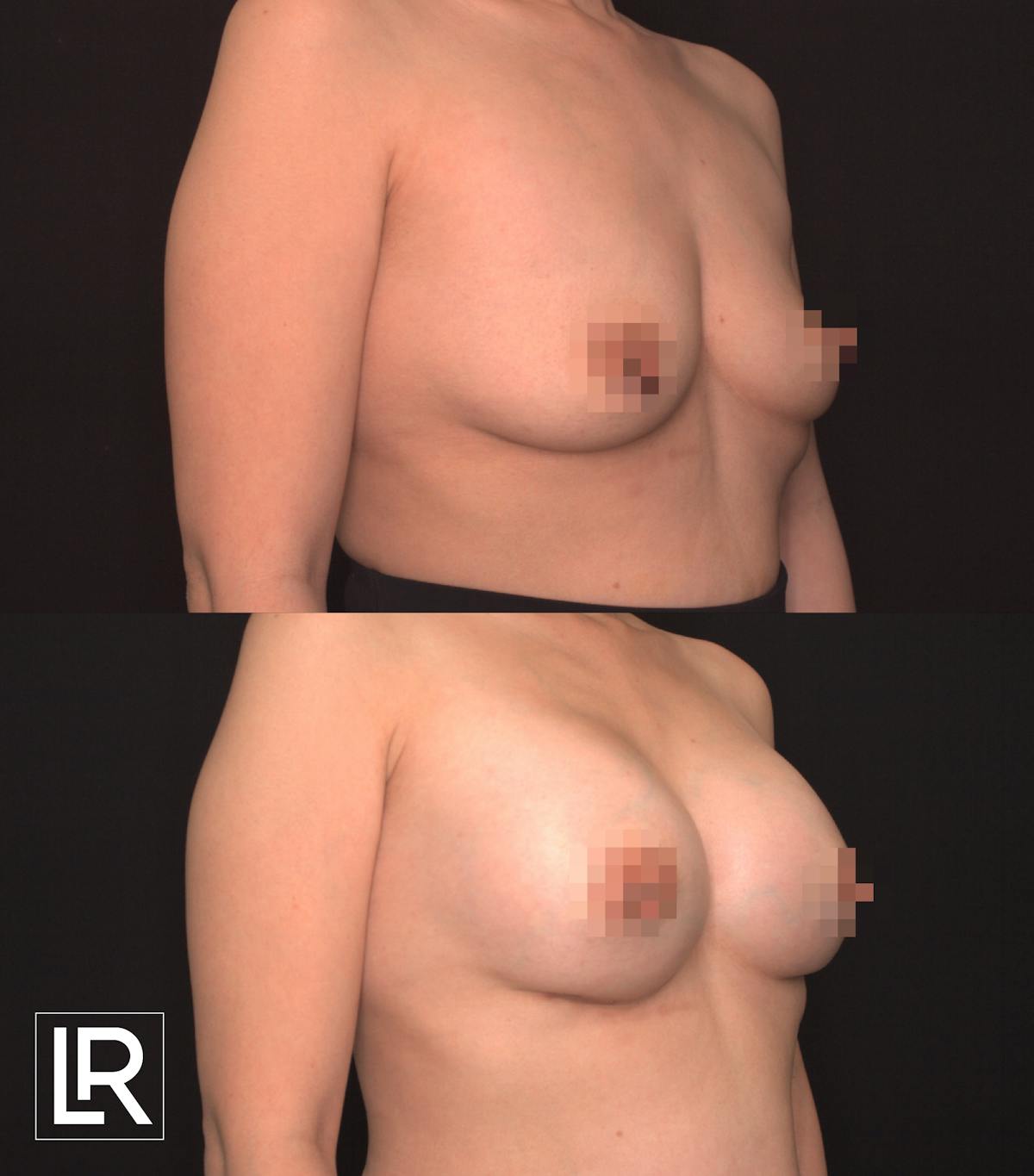 Breast Augmentation Before & After Gallery - Patient 906577 - Image 2