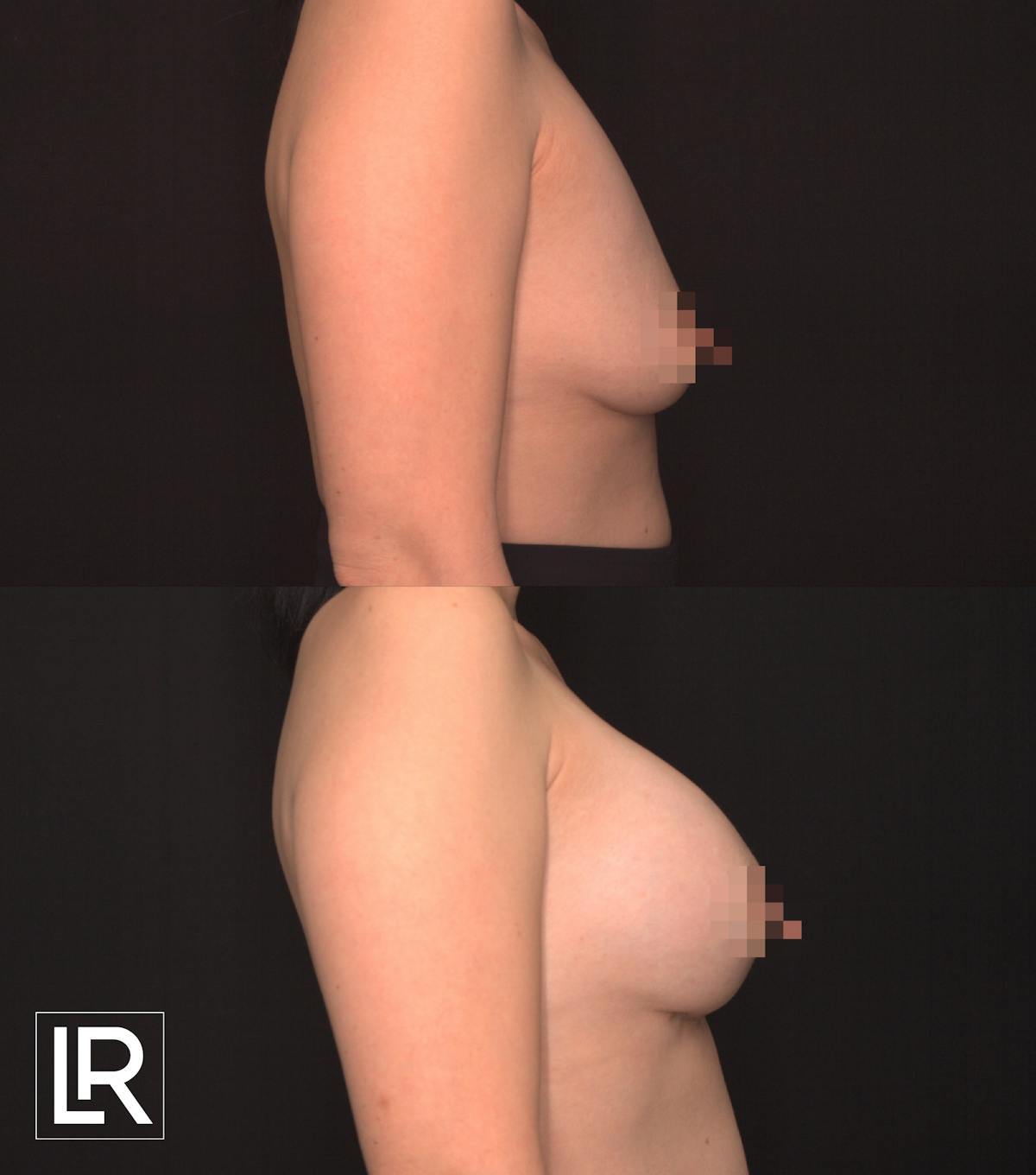 Breast Augmentation Before & After Gallery - Patient 906577 - Image 3