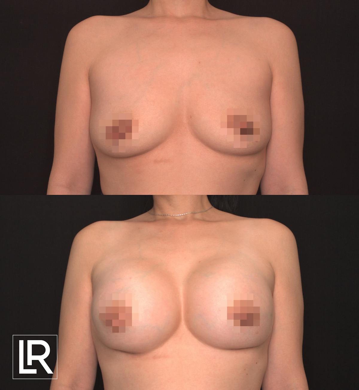 Breast Augmentation Before & After Gallery - Patient 906577 - Image 1