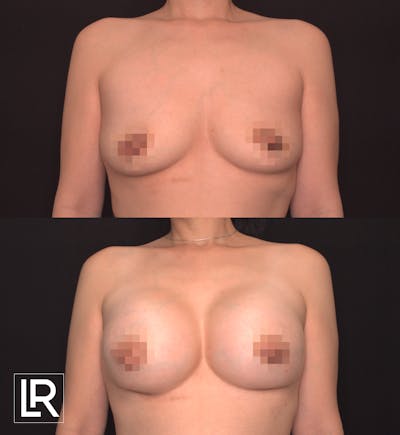 Breast Augmentation Before & After Gallery - Patient 906577 - Image 1