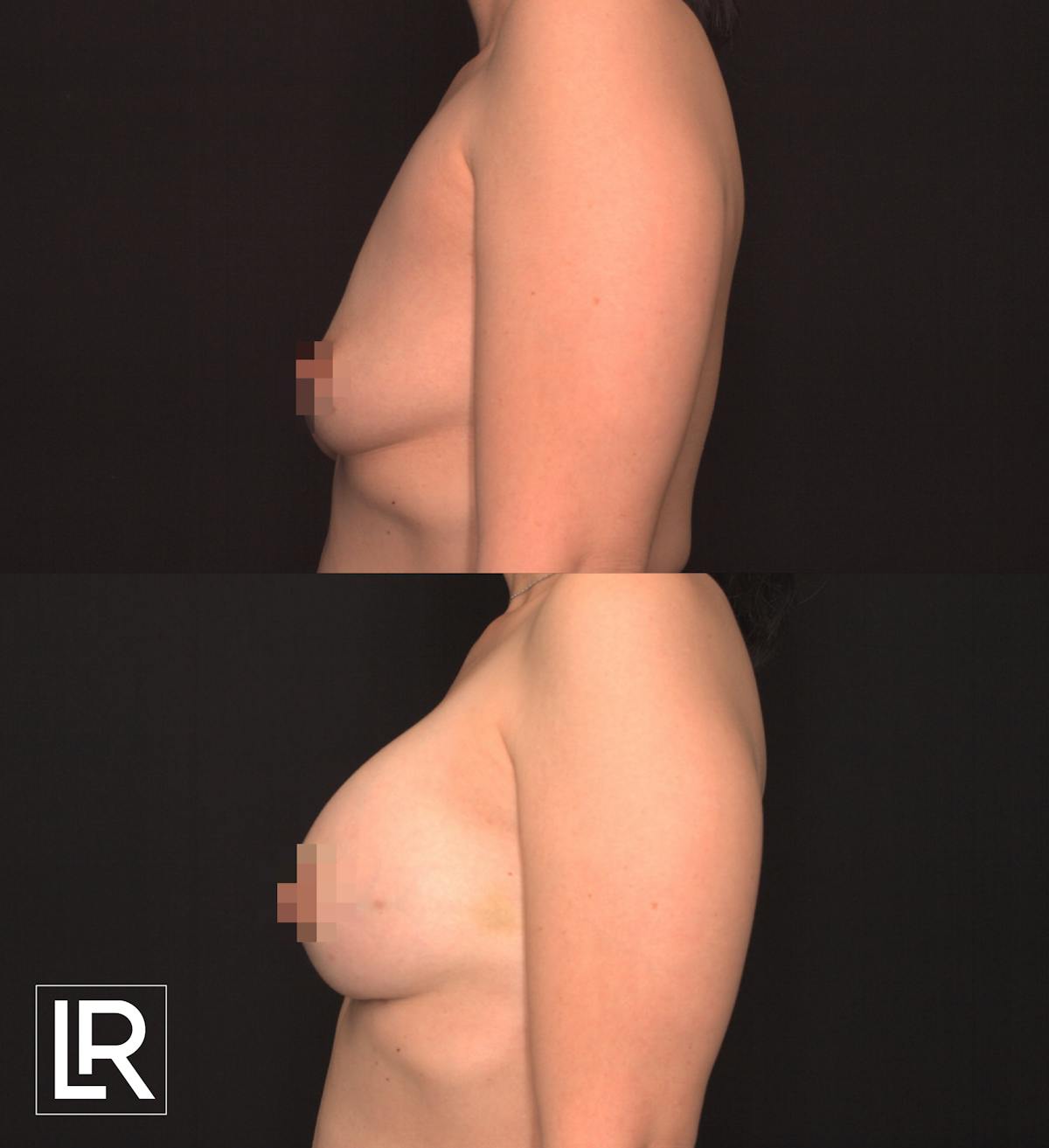 Breast Augmentation Before & After Gallery - Patient 236471 - Image 3