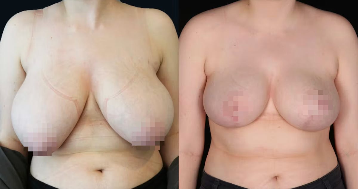 Breast Lift Before & After Gallery - Patient 343983 - Image 1