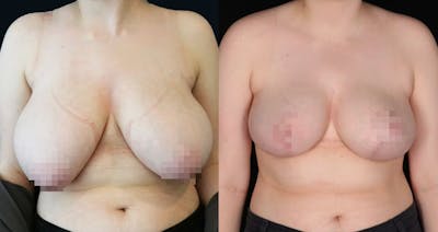 Breast Lift Before & After Gallery - Patient 343983 - Image 1