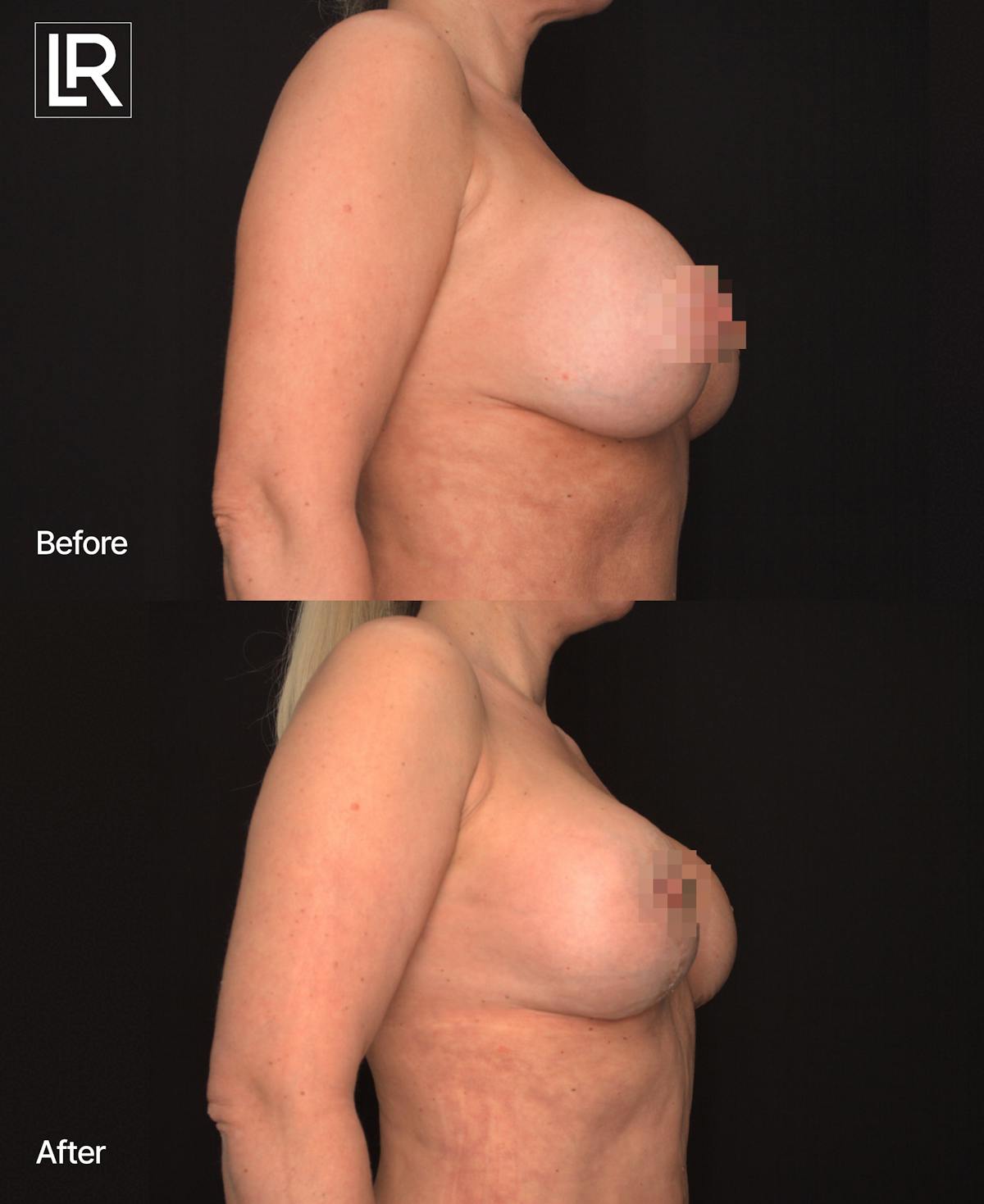 Breast Reconstruction Before & After Gallery - Patient 267238 - Image 3