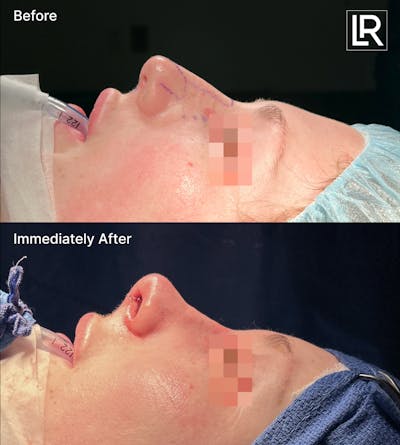 Rhinoplasty Before & After Gallery - Patient 328841 - Image 1