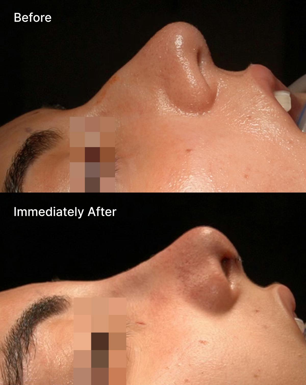 Rhinoplasty Before & After Gallery - Patient 875064 - Image 1
