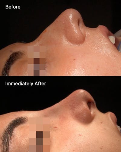 Rhinoplasty Before & After Gallery - Patient 875064 - Image 1