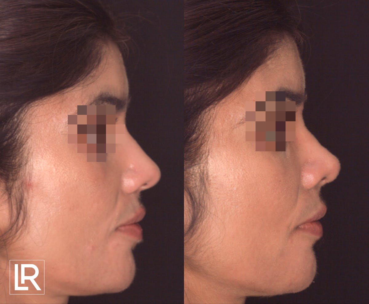 Rhinoplasty Before & After Gallery - Patient 206028 - Image 3
