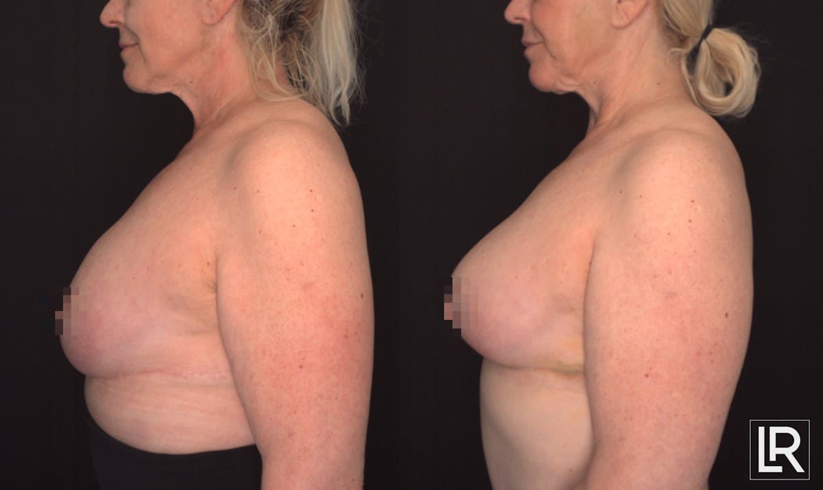 Breast Augmentation Before & After Gallery - Patient 319203 - Image 2
