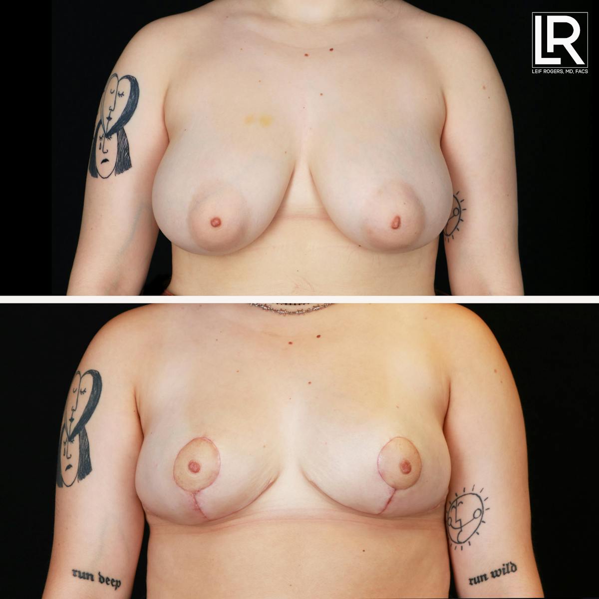 Breast Reduction Before & After Gallery - Patient 346117 - Image 1
