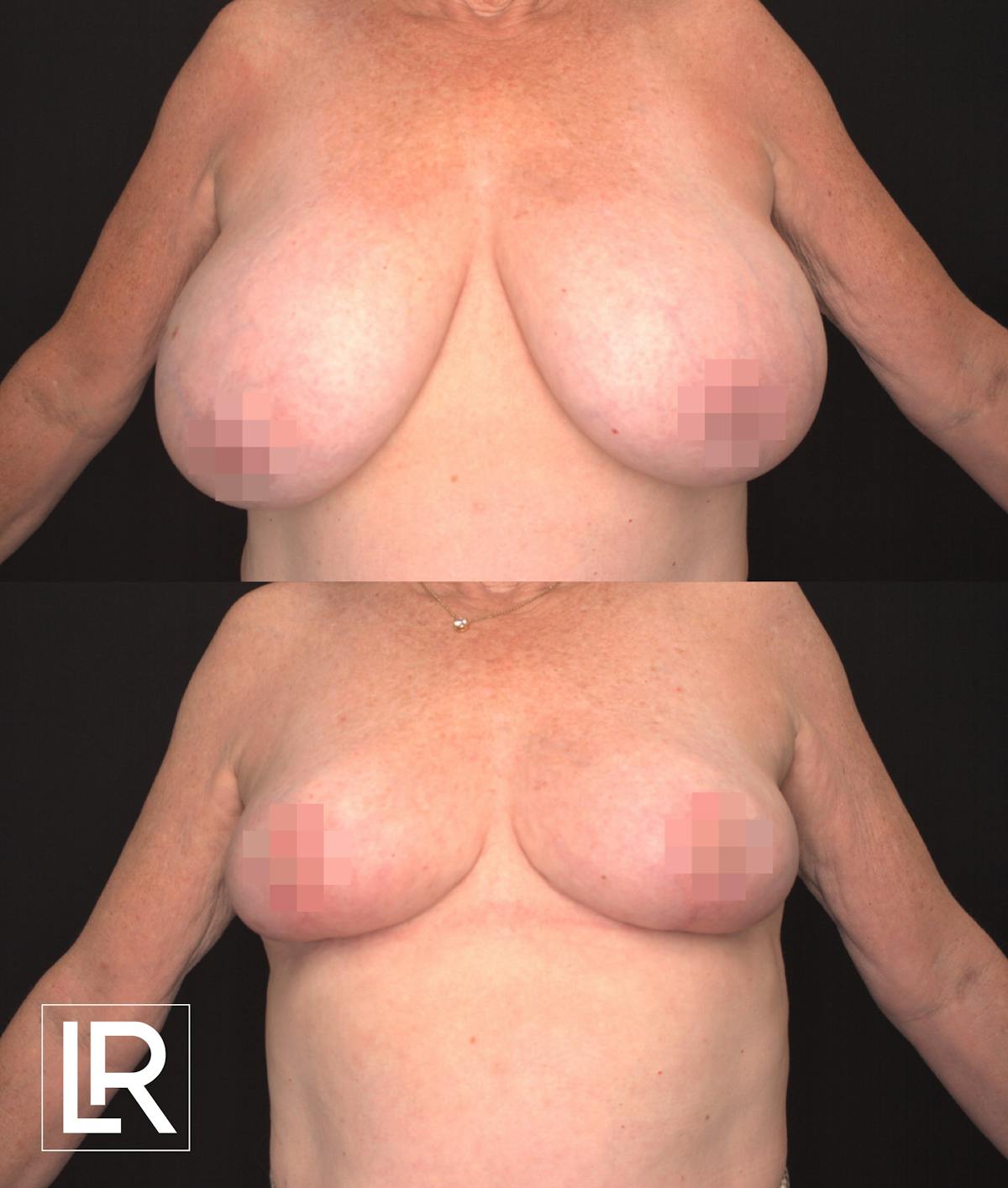 Breast Reduction Before & After Gallery - Patient 399178 - Image 1