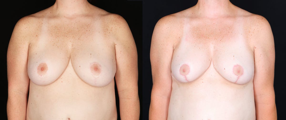 Breast Reduction Before & After Gallery - Patient 400427 - Image 1