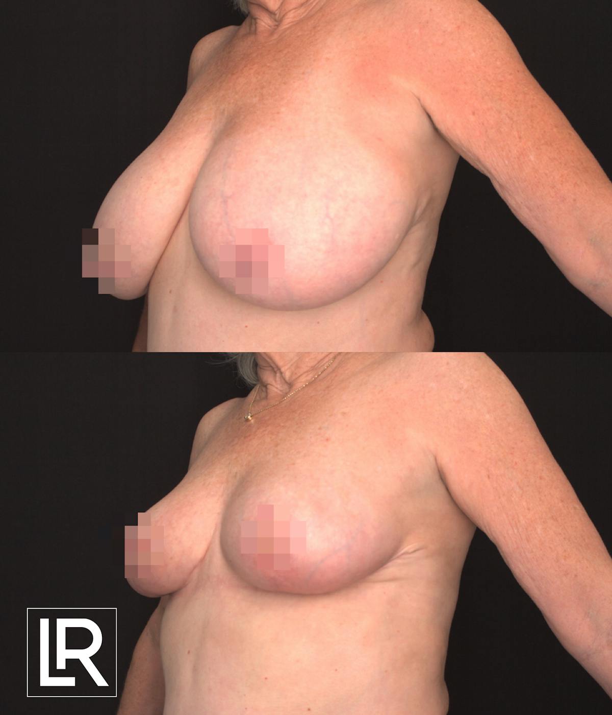 Breast Reduction Before & After Gallery - Patient 399178 - Image 2