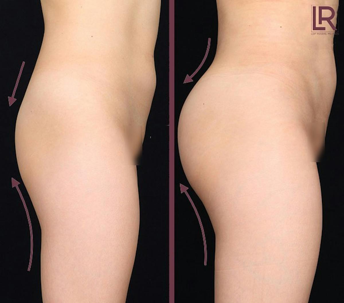 Buttocks Lift Before & After Gallery - Patient 129695 - Image 1