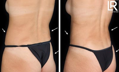 Buttocks Lift Before & After Gallery - Patient 976710 - Image 1