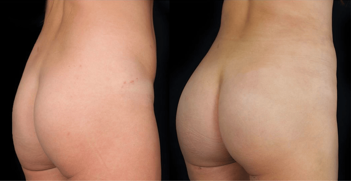 Buttocks Lift Before & After Gallery - Patient 291097 - Image 1