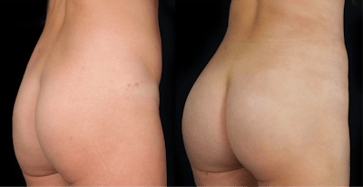 Buttocks Lift Before & After Gallery - Patient 291097 - Image 1