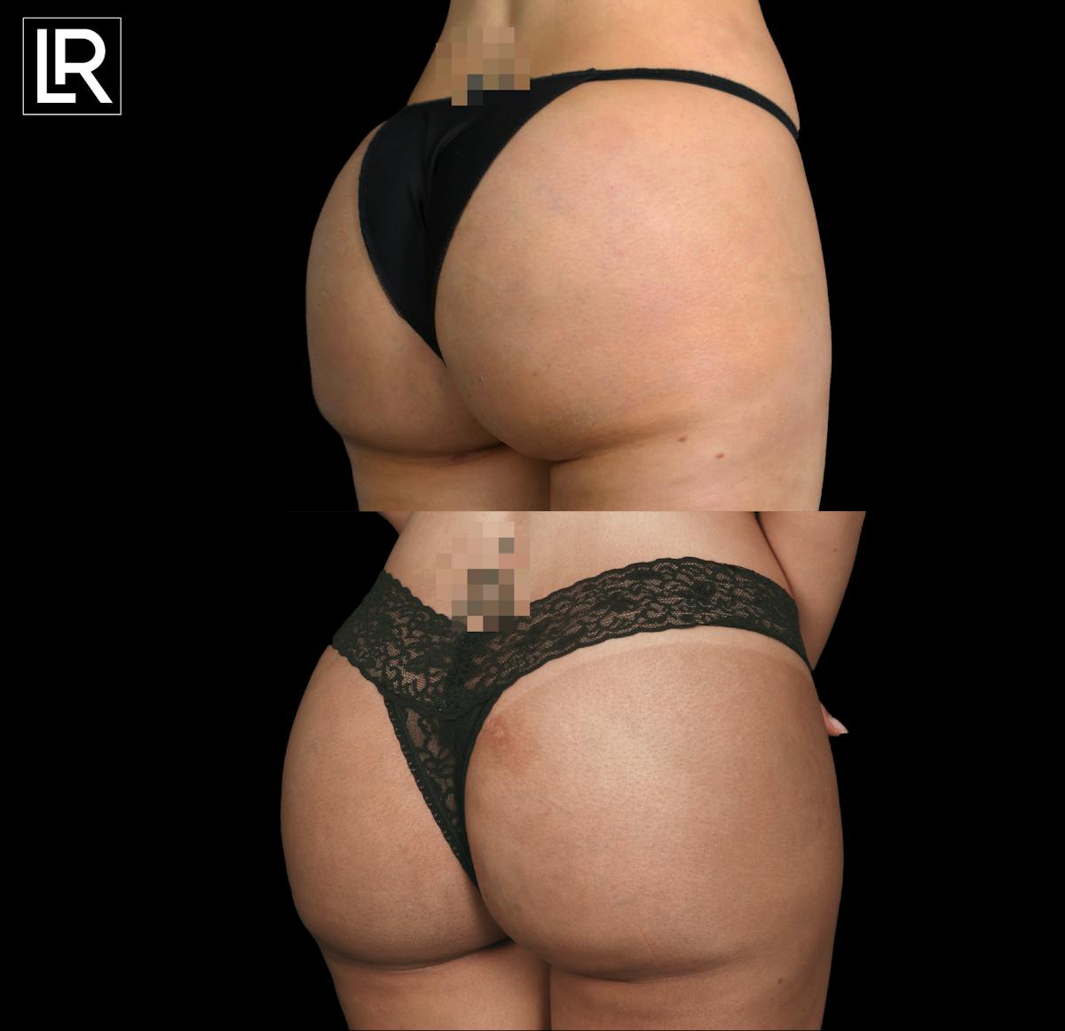 Buttocks Lift Before & After Gallery - Patient 351495 - Image 2