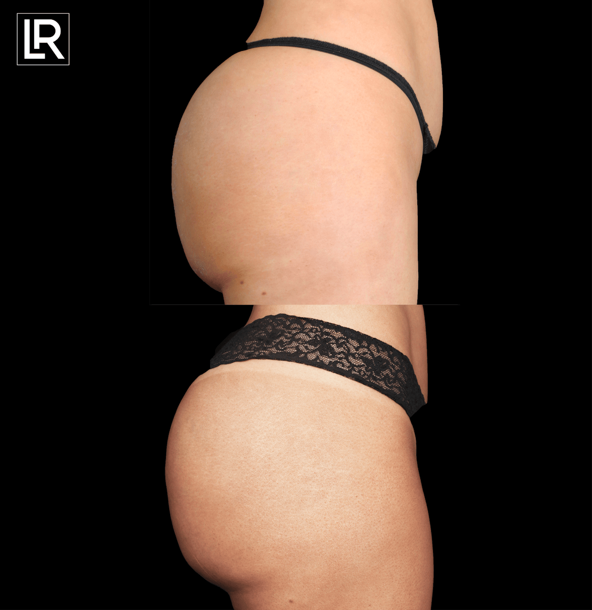 Buttocks Lift Before & After Gallery - Patient 351495 - Image 3