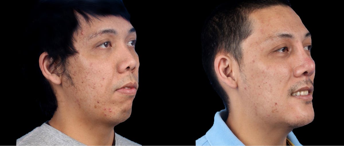 Chin Implant Before & After Gallery - Patient 956694 - Image 1