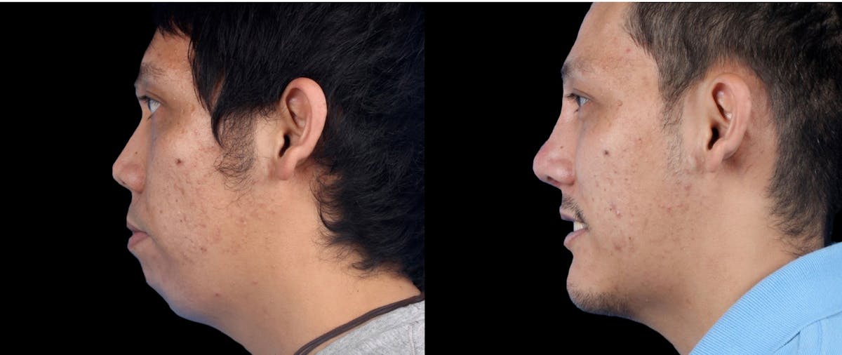 Chin Implant Before & After Gallery - Patient 956694 - Image 2