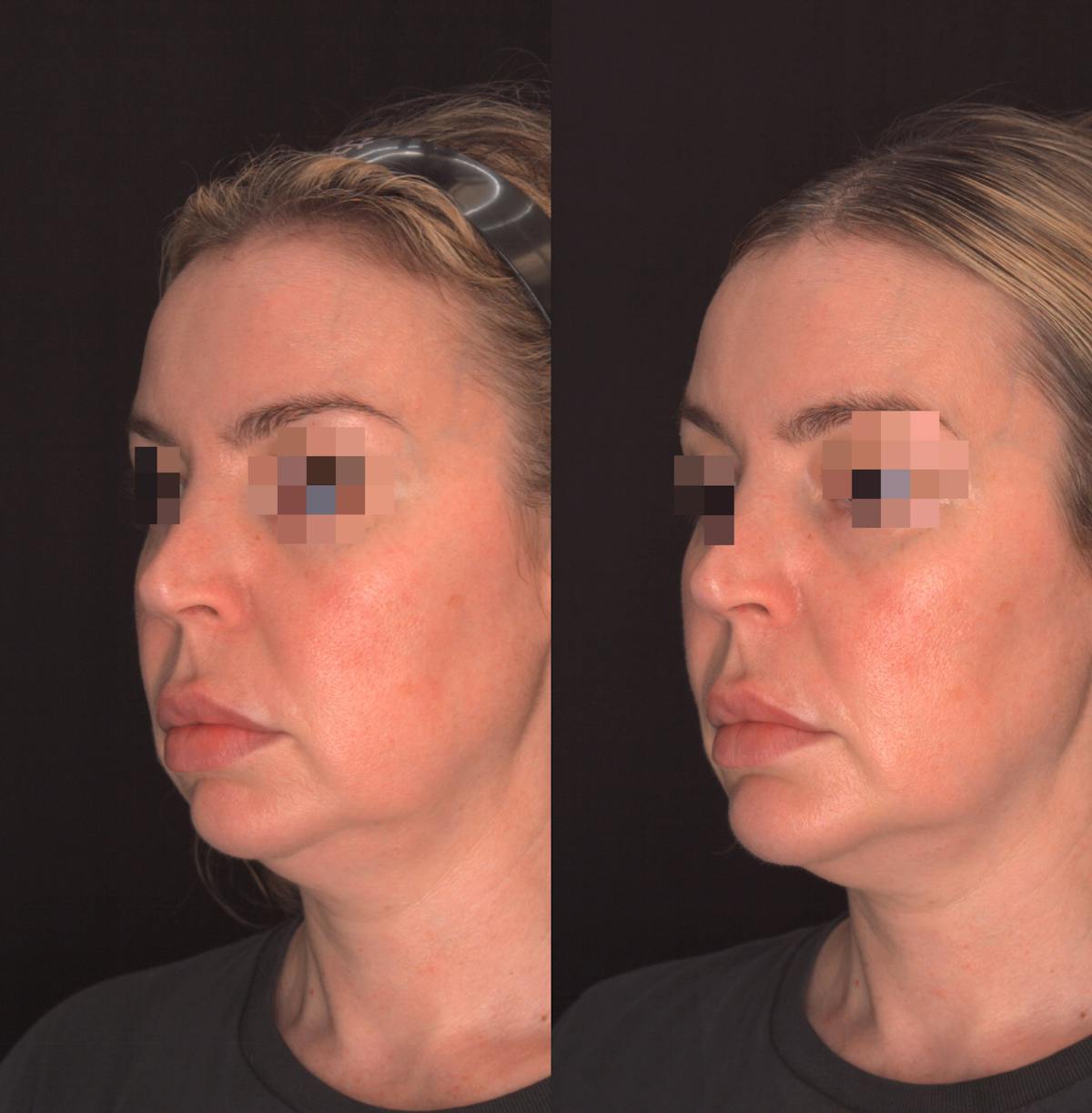 Chin Implant Before & After Gallery - Patient 302798 - Image 2