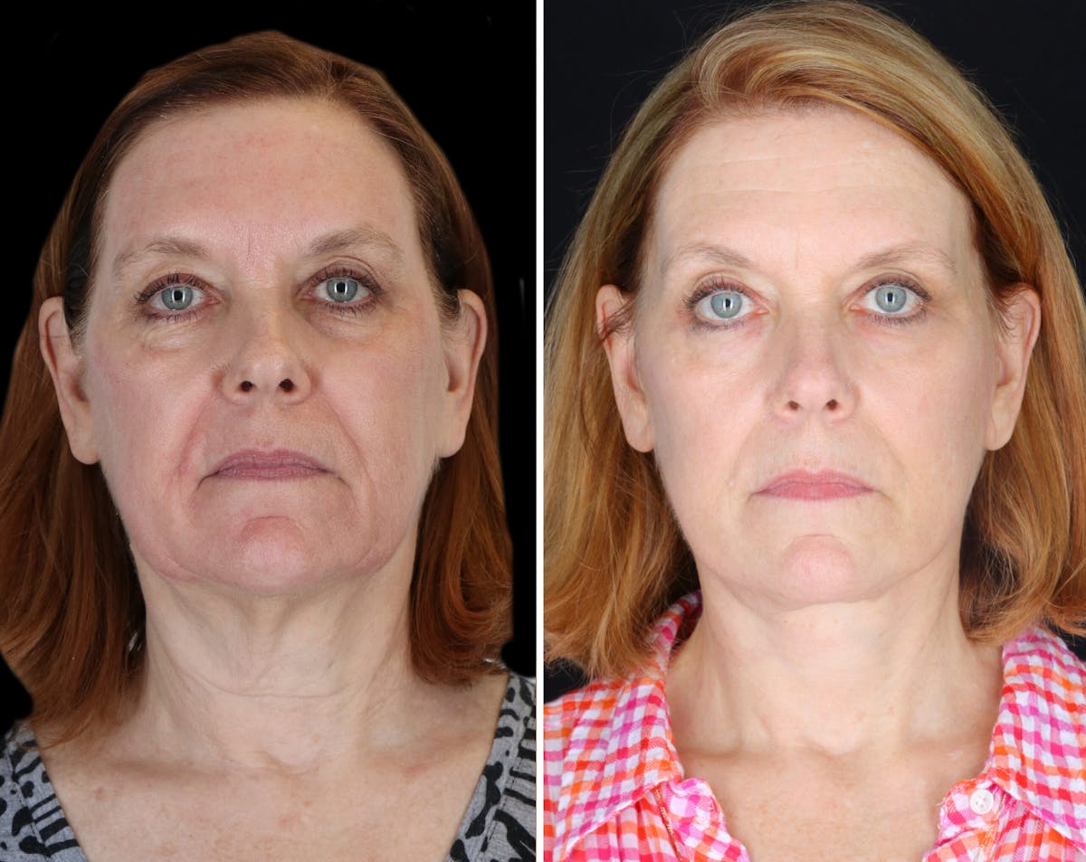 Facelift Female Before & After Gallery - Patient 424340 - Image 1