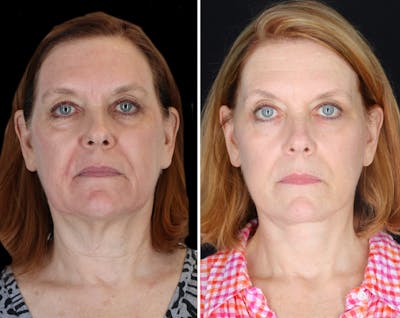 Facelift Female Before & After Gallery - Patient 424340 - Image 1