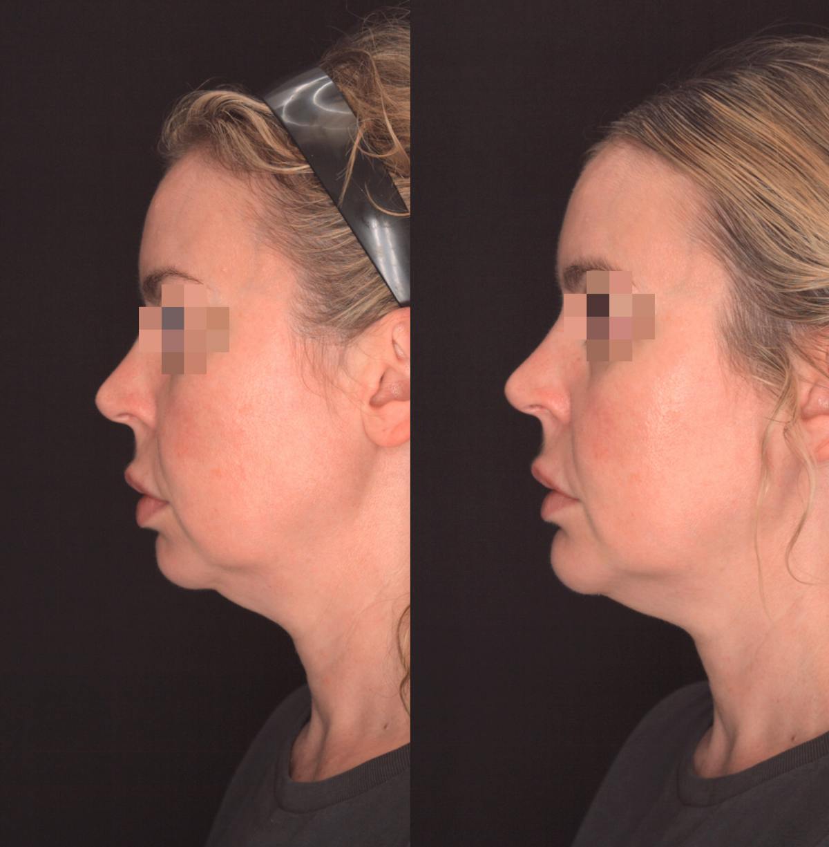 Chin Implant Before & After Gallery - Patient 302798 - Image 1