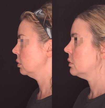 Chin Implant Before & After Gallery - Patient 302798 - Image 1