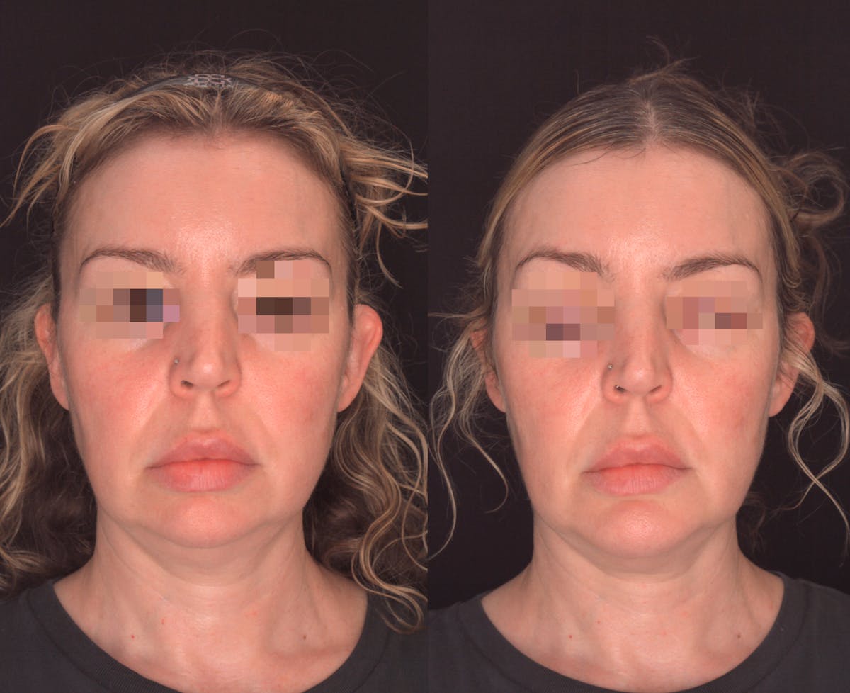 Chin Implant Before & After Gallery - Patient 302798 - Image 3