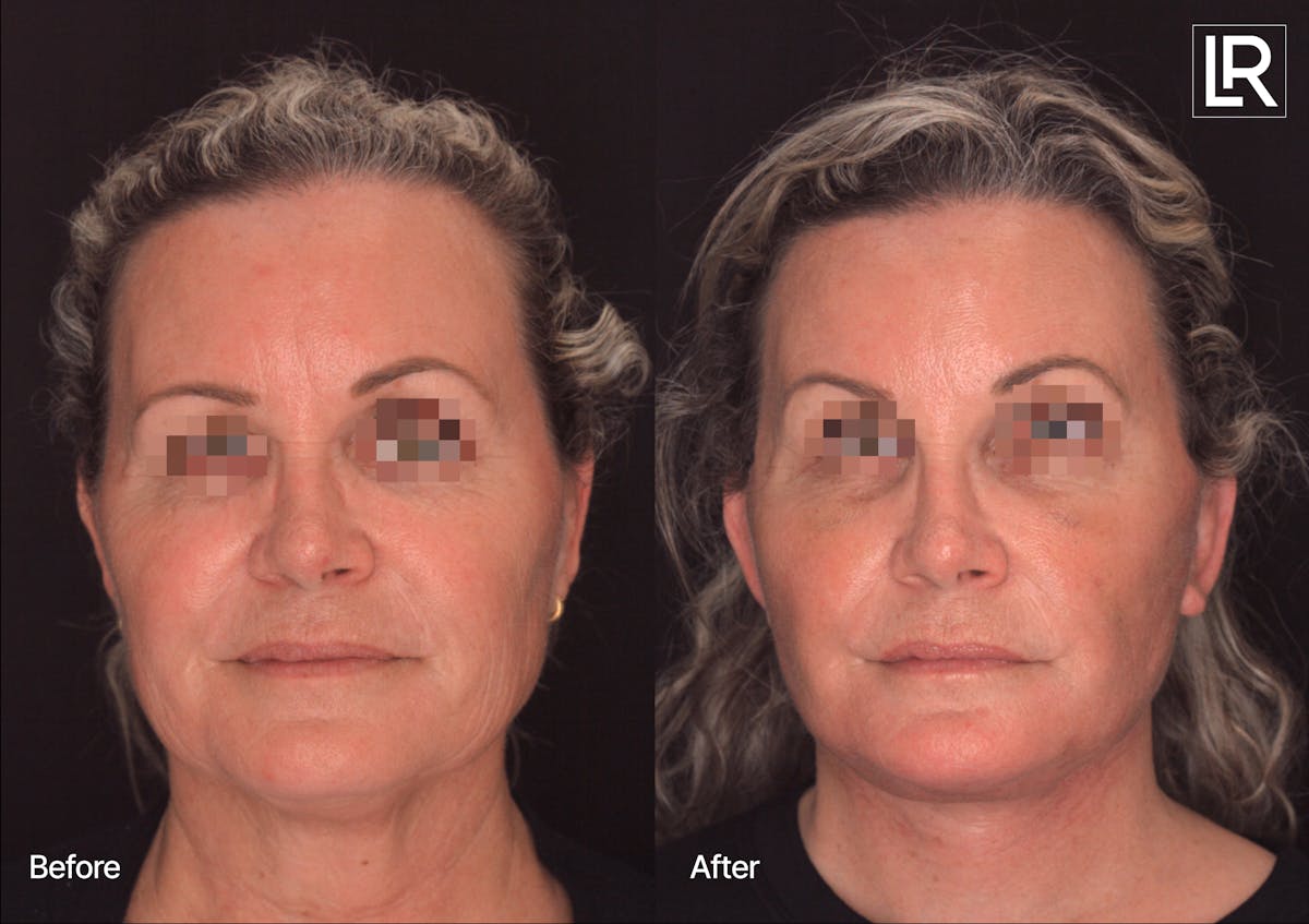 Facelift Female Before & After Gallery - Patient 886955 - Image 1