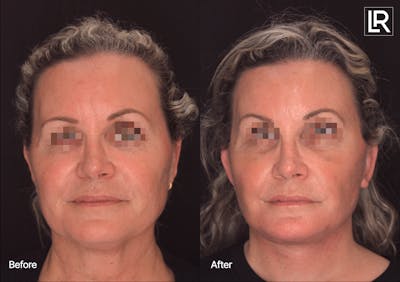 Facelift Female Before & After Gallery - Patient 886955 - Image 1