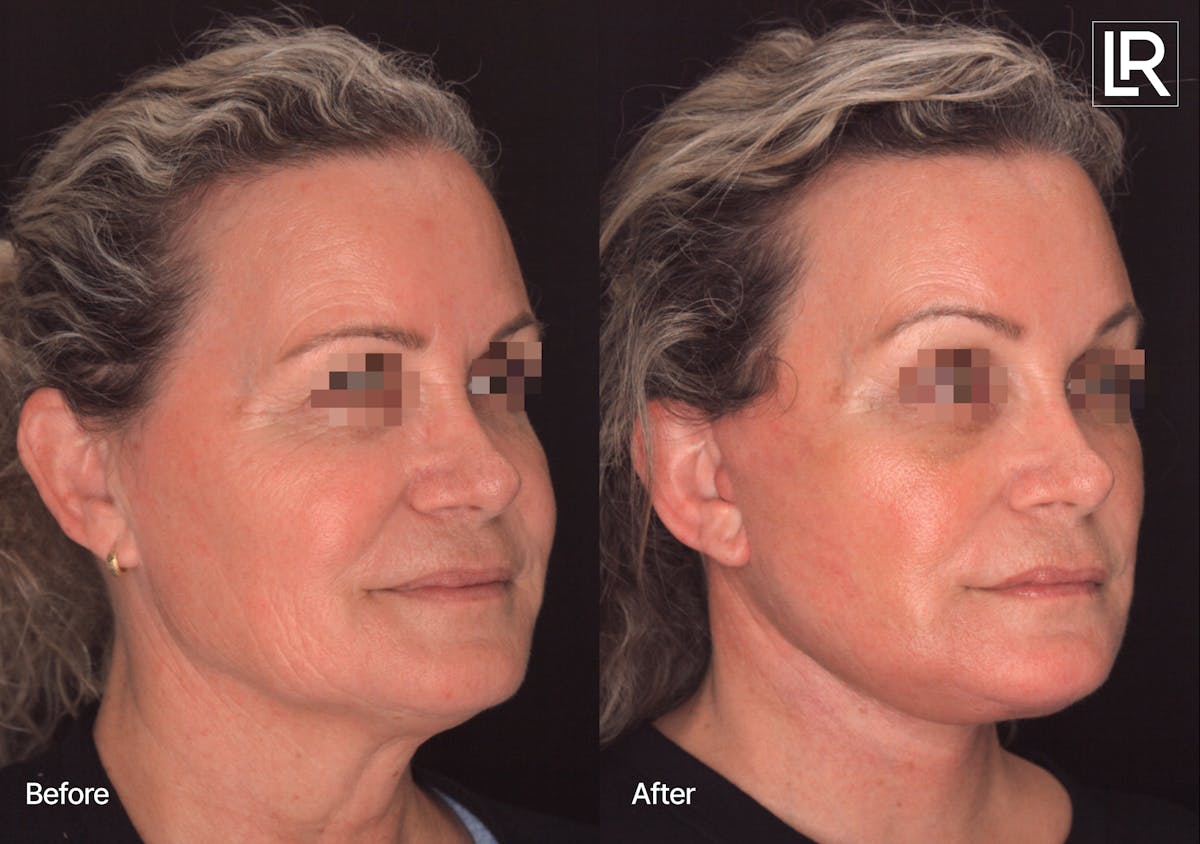 Facelift Female Before & After Gallery - Patient 886955 - Image 2