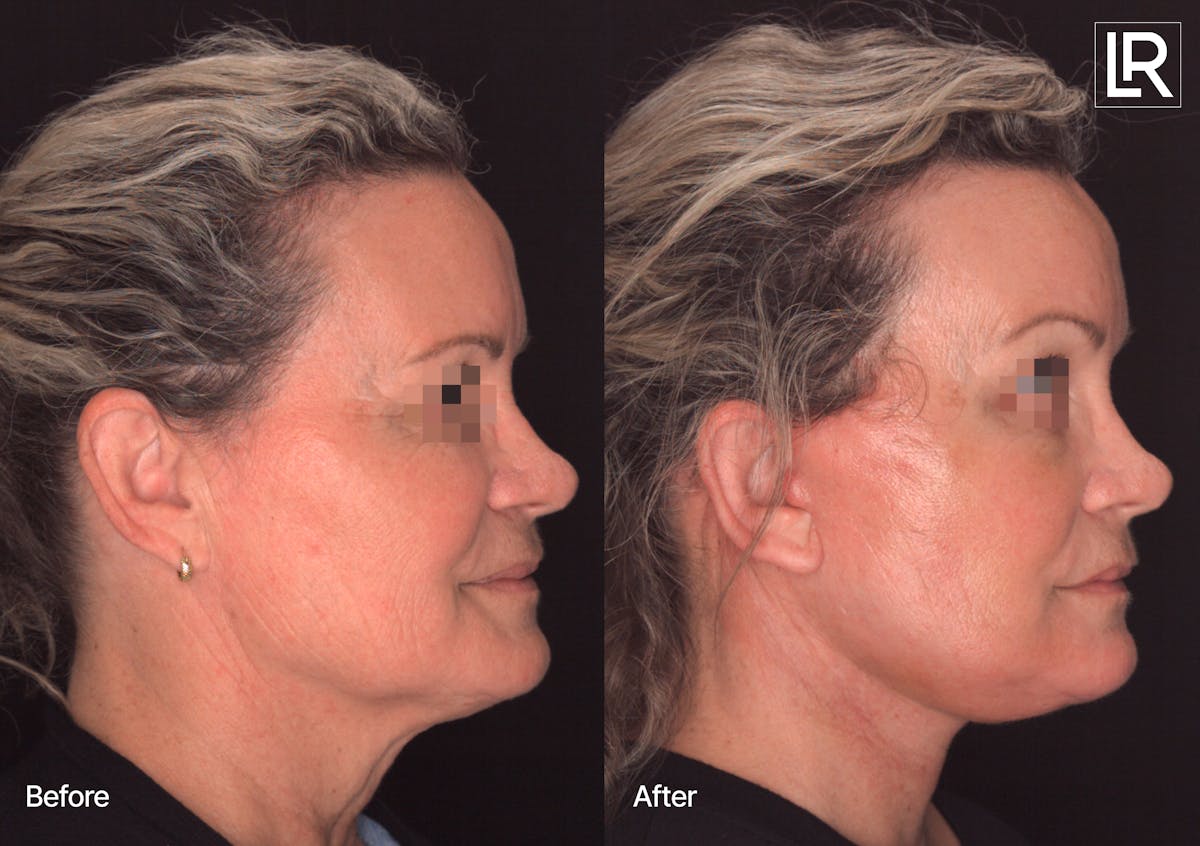 Facelift Female Before & After Gallery - Patient 886955 - Image 3