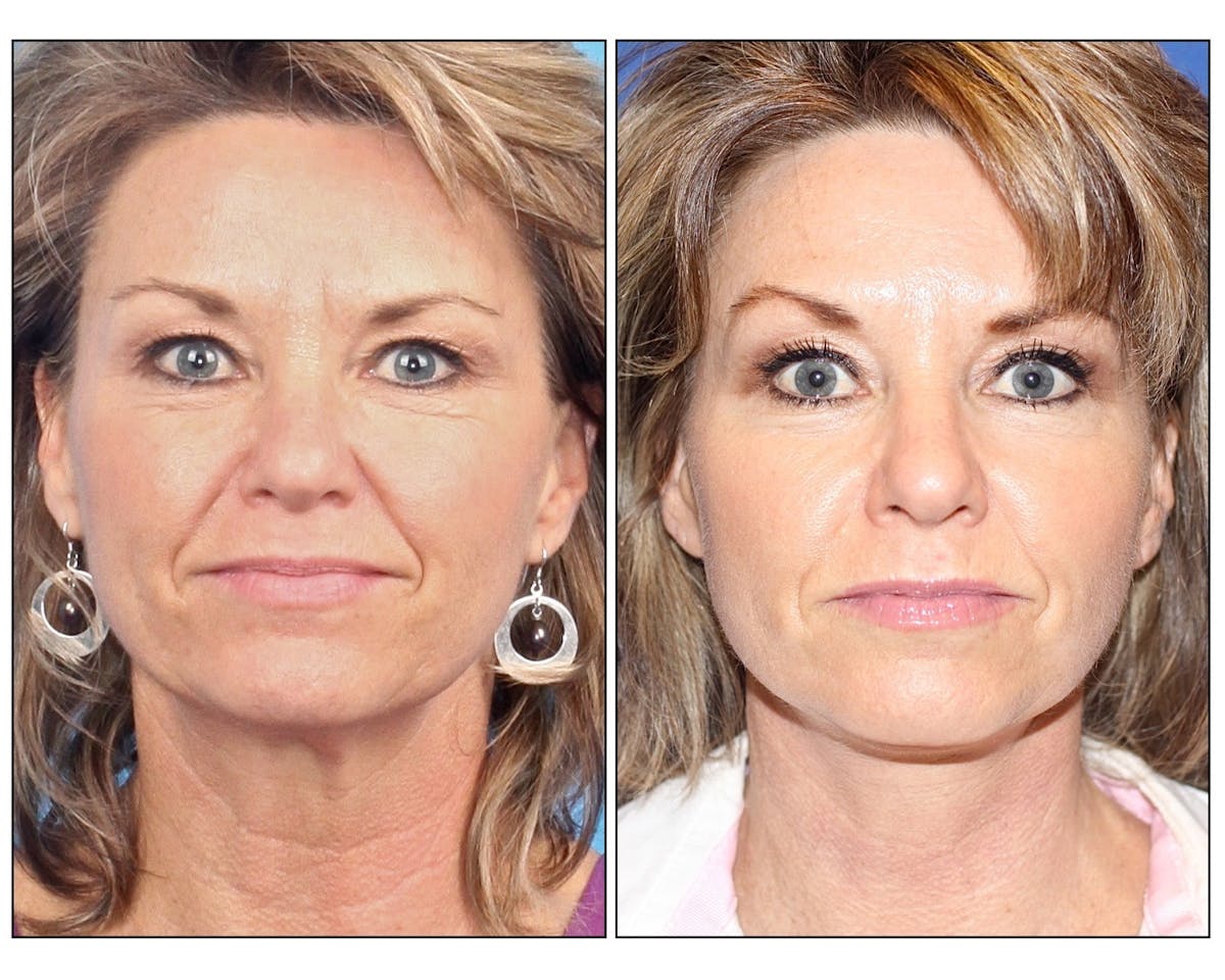 Facelift Female Before & After Gallery - Patient 397174 - Image 1