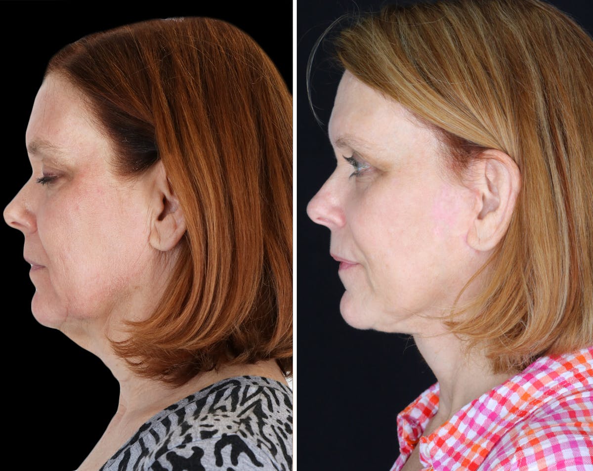 Facelift Female Before & After Gallery - Patient 424340 - Image 2