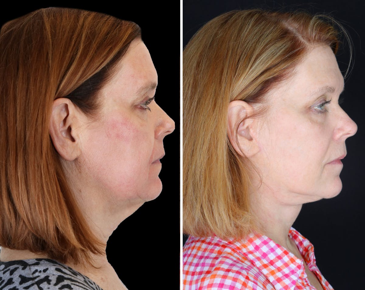 Facelift Female Before & After Gallery - Patient 424340 - Image 3