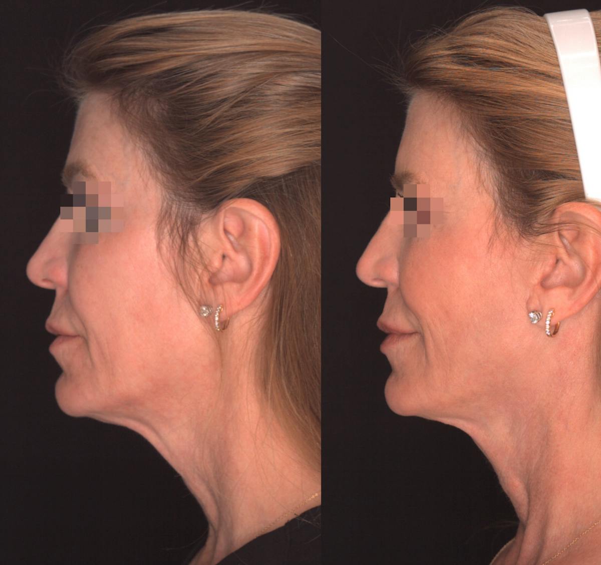 Facelift Female Before & After Gallery - Patient 424489 - Image 3